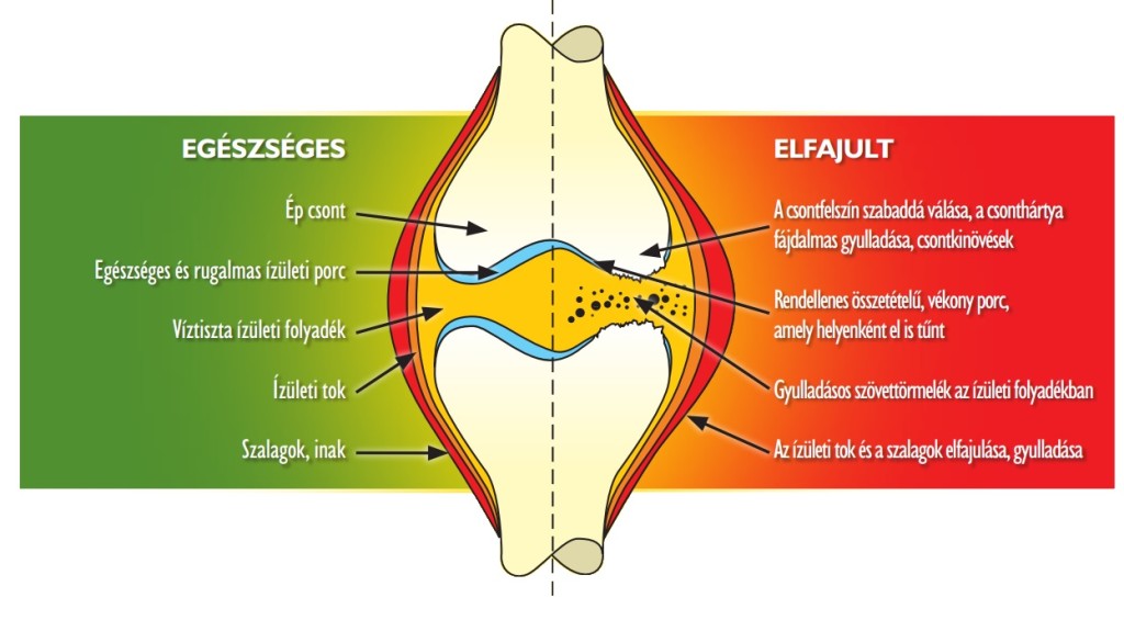 ízületi porc fáj)